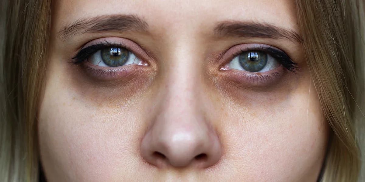 Why You Should Treat Under-Eye Dark Circles & Puffiness (Not Just Hide Them)