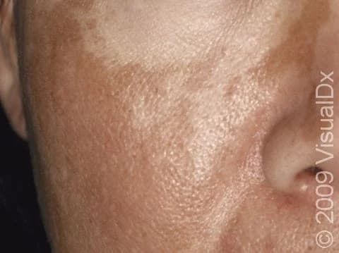 Why Is Your Skin Getting Darker? The Truth No One Told You (And How to Fix It)