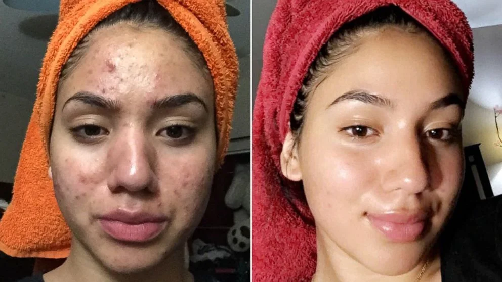 How a Simple Skin Test Helped Susmita Fix 3 Years of Acne Struggles